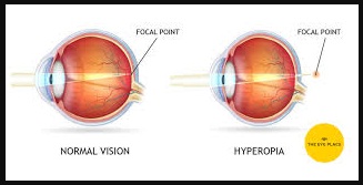 Hypermetropia-phy Form Four